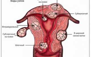 Современные способы лечения миомы матки