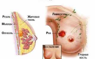 Самые распространенные болезни груди: описание, диагностика и лечение