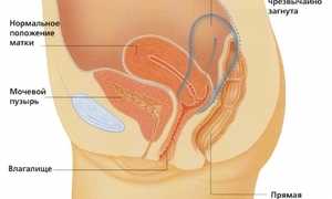 Загиб матки: причины, последствия и способы лечения