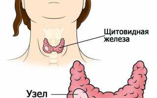 Узелки на щитовидной железе: причины, симптомы и лечение