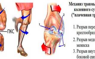 Растяжение связок коленного сустава — последствия при отсутствии лечения
