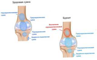 Боль и опухлость колена без ушиба: что делать и чего делать нельзя