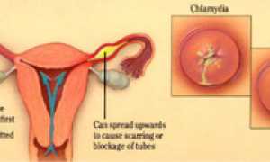 Причины возникновения и симптомы гонореи у женщин, лечение