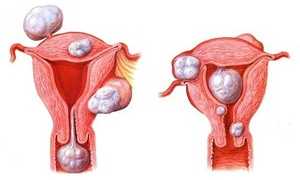 Чем отличается миома от фибромы матки: причины и симптомы болезни