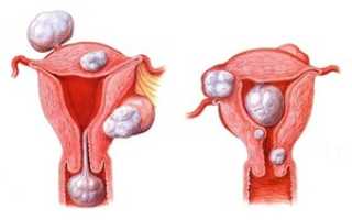 Чем отличается миома от фибромы матки: причины и симптомы болезни