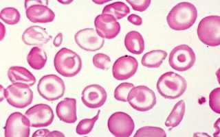 Пойкилоцитоз в общем анализе крови: причины возникновения, что это такое