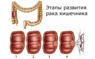 Методы лечения народными средствами рака прямой кишки