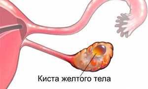 Киста желтого тела левого яичника: симптомы и лечение